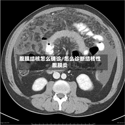 腹膜结核怎么确诊/怎么诊断结核性腹膜炎